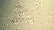 - rozlišení Ery dle morfologie lze ur it p vod krvácení a) dysmorfní erytrocyty - tzv.