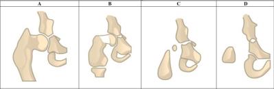 Obrázek - 1 typ Klasifikace IX: Ve srovnání dle Aitkena s druhou stranou není stehenní kost úplně vyvinutá, ale je normálního tvaru. Standardní je instabilita kolenního kloubu a zkrat je 5-20%.