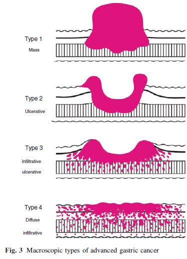 Karcinom žaludku - morfologie Makroskopicky: exofytický x endofytický x infiltrativní (scirhotický x nescirhotický) Mikroskopicky (dle Laurena) difuzní x intestinální Linitis