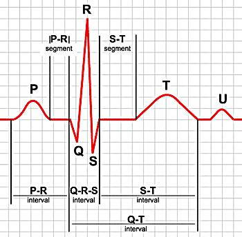 2.3 EKG křivka Obr. 2.4: Rozmístění hrudních svodů EKG křivka, která se zobrazí na elektrokardiogramu má svůj předepsaný fyziologický průběh.