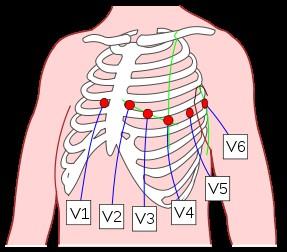 5 je znázorněn průběh křivky zobrazené elektrokardiografem. Na této křivce lze rozeznat vlny P, T případně U a kmity Q, R a S.