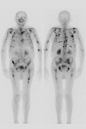 Nukleární medicína Gama kamera Signály z digitálního snímače nebo fotonásobičů nesou informaci o poloze scintilačních událostí.