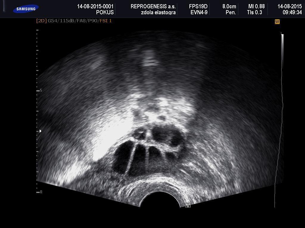 Obr. 2: Ultrazvukový obraz nastimulovaného ovária (E. Blahová, ReproGenesis, 2015)