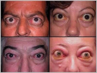 Mezi nejběžnější symptomy spojené s hypertyreózou patří únava, nervozita, bušení srdce, palpitace, nesnášenlivost horka a hubnutí. Tyto symptomy se vyskytují u více jak poloviny nemocných.