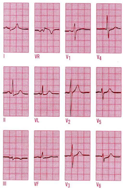 Angina pectoris klid