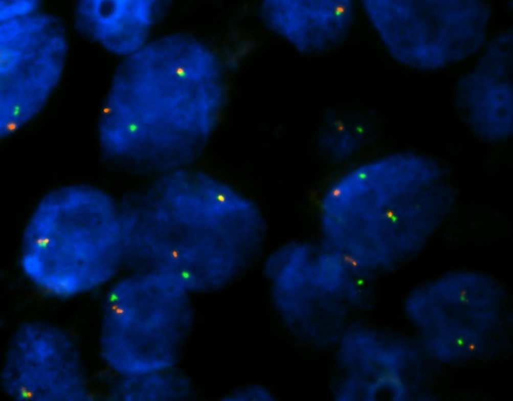 Analýza ETV6 zlomu pomocí FISH FISH analysis of ETV6 gene (12p13) using break apart rearrangement probe - Vysis ETV6 Break Apart FISH Probe Kit (Abbott