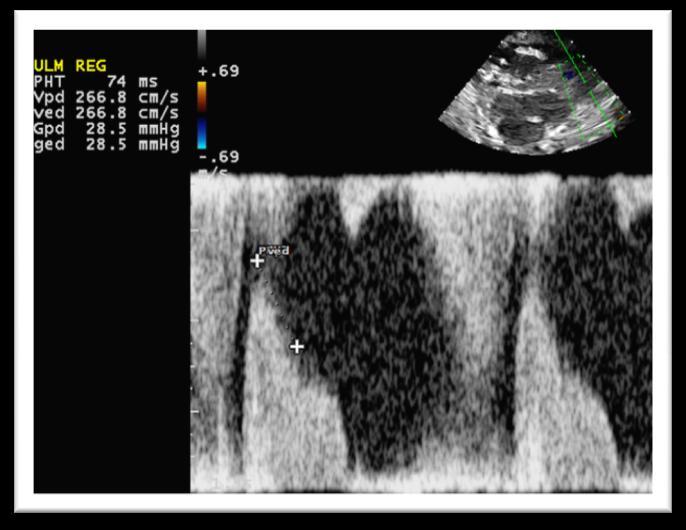 Vyšetření regurgitujících proudů Aorta (nutno potvrdit pomocí PW, měřit pomocí