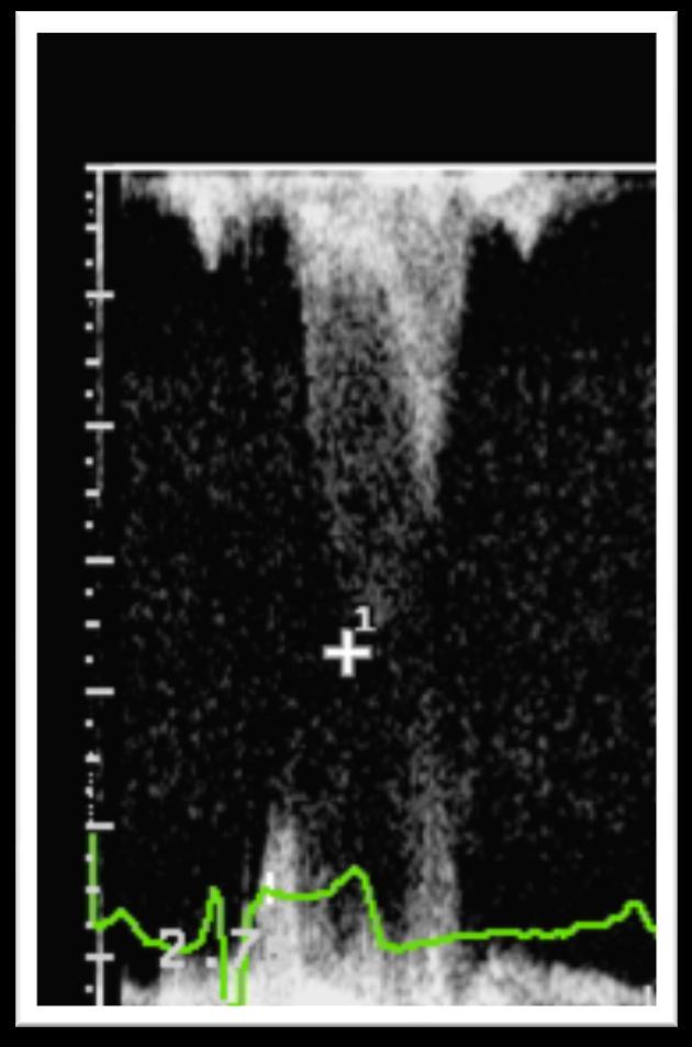 Vyšetření stenózy Normální impulzní gradient ~10 mm Hg Vyšší tlaky ukazují na stenózu