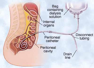 Peritoneální dialýza Peritoneální dialýzu si pacient může provádět i doma.