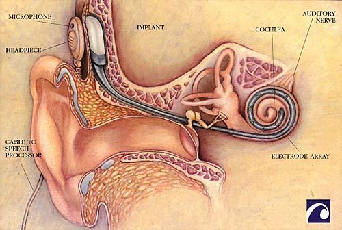 Kochleární implantát Elektronický kochleární implantát může částečně nahradit Cortiho orgán, zvlášť u dětí, které mají neporušený sluchový nerv.