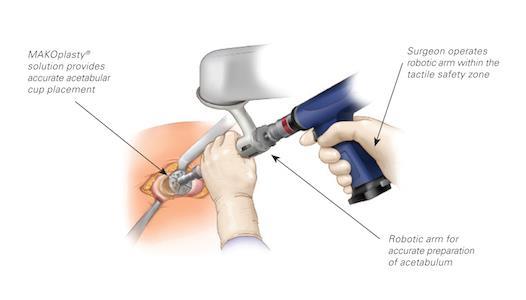 Umístění implantátu jamky kyčelního kloubu (acetabula) Roboty v ortopedické chirurgii.