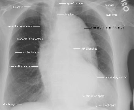 Aneuryzma