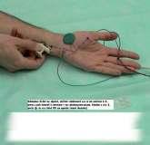 abductor digiti minimi. Fig. 10. The technique for the ulnar nerve examination.