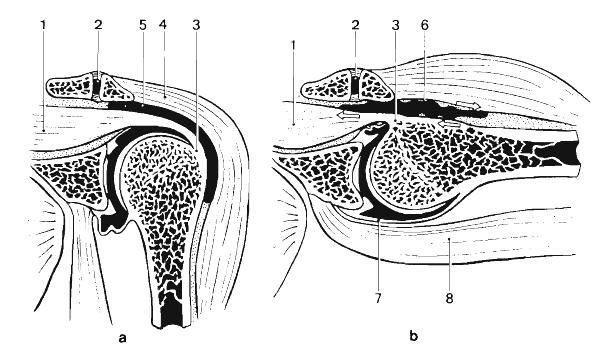 subdeltoidea, ačkoli nejde o zánět, ale spíše o důsledek mikrotramat nebo iritací uvnitř kloubu (Véle, 2006).