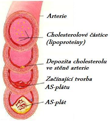 Typy aterosklerózy Z patologicko-anatomického hlediska rozlišujeme 3 základní typy aterosklerózy 1) Tukové proužky ty jsou nejběžnější a vyskutují se pravidelně již v cévách u dětí.