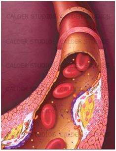 Úvod Ateroskleróza je jedním z nejčastějších onemocnění, které velmi často vede k rozvoji i dalších kardiovaskulárních onemocnění.