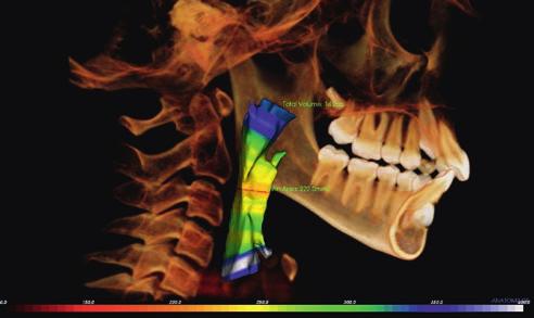 Podpora u detekce takových poruch jako jsou cysty, nádory, léze nebo změny patologické čelisti a zamezení chirurgických komplikací. Endodoncie: trojrozměrné hodnocení kořenů.