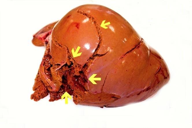 KAZUISTIKA ÚPLNÝM ZÁVĚREM Vnitřní prohlídka: Splývající trhliny jater. Krev v dutině břišní (1500 ml). Těžká steatosa jater. Alkohol: 3,55 g/kg.