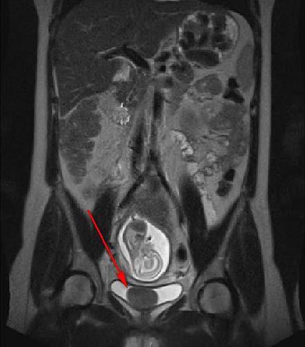 247 močového měchýře řadíme leiomyomy, fibromyomy, rhabdomyomy, lipomy, papilomy, fibromy, myxomy, angiomy (1). Leiomyom, nejčastější benigní nádor močového měchýře, je původu mezenchymálního.