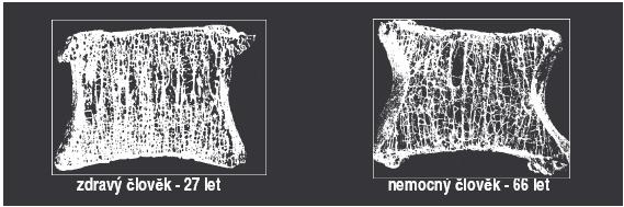 4.3 Vlivy ovlivňující materiálové vlastnosti obratlů Vlivů, které ovlivňují materiálové a mechanické vlastnosti kostí je mnoho. Může to být věk, fyzická zdatnost, ale mohou to být například i nemoci.