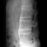 2.7 Patologická morfologie ankylozující spondylitidy U AS jsou zánětem postiženy klouby axiálního skeletu, zejména sakroiliakálních (SI) kloubů a páteře.