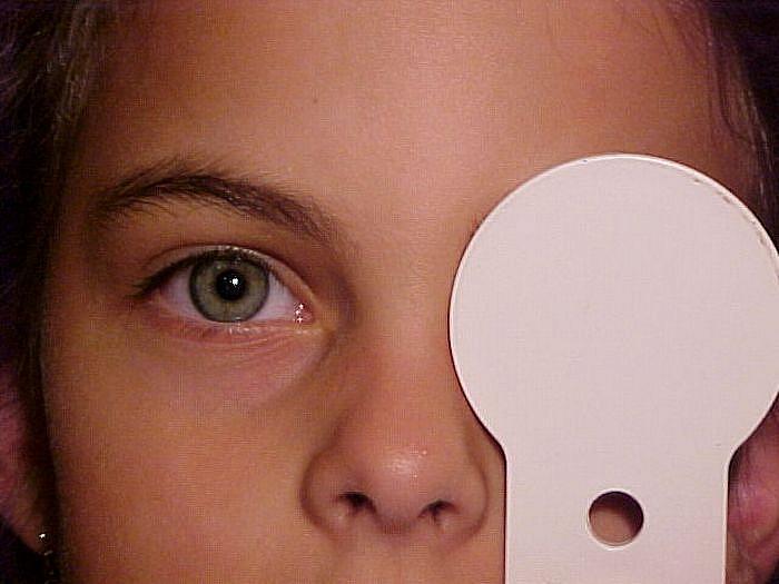 5.4 Postavení a pohyblivost očí Postavení očí je vyhodnocováno pomocí korneálního reflexu na světlo, binokulárního testu na červený reflex (Brücknerův test) nebo pomocí zakrývacího testu.