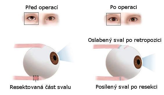 funkce. Kombinovaná operace na dvou svalech je znázorněna na obr. 19. Po operaci musí zůstat oko ve všech směrech stejně pohyblivé.