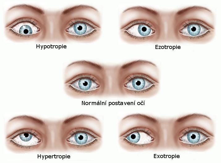 3 Popis a klasifikace amblyopie Klasifikace amblyopie sleduje klinické podmínky, které jsou odpovědné za její vývoj.