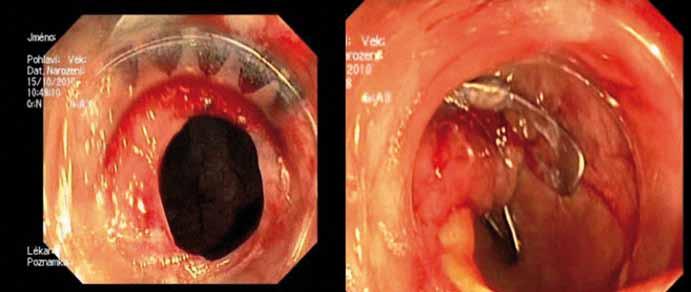 Hereditárny Nekonečná endoskopická angioedém ako cesta príčina aneb bolestí endoskopická brucha chirurgie nový obor? Obr. 1.