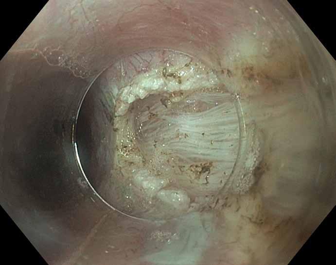 Hereditárny Nekonečná endoskopická angioedém ako cesta príčina aneb bolestí endoskopická brucha chirurgie nový obor? Obr. 8. Nádherné zobrazení zevní podélné vrstvy m.