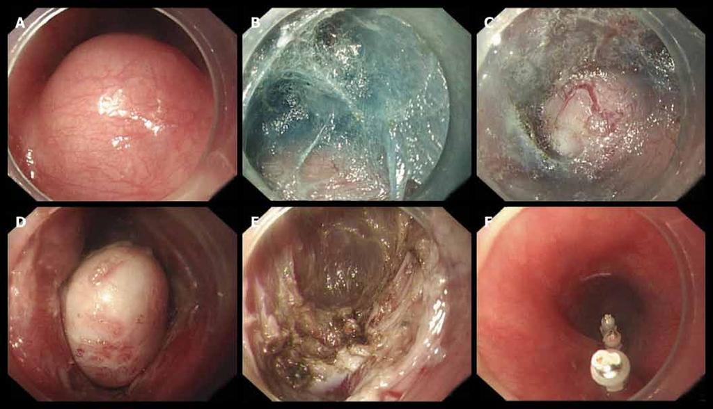 Nekonečná endoskopická Hereditárny cesta aneb angioedém endoskopická ako chirurgie príčina bolestí nový brucha obor?