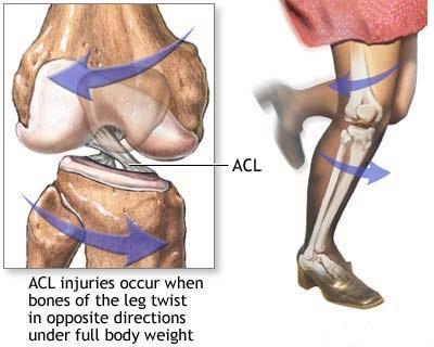Klasifikace poranění ligament (Dungl, 2005): Obecně lze poranění ligament rozdělit na tři stupně: - distenze tahem dojde k protažení a eventuelně k ojedinělým trhlinám jednotlivých vláken, kontinuita