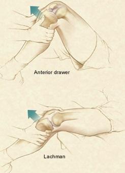 Test přední zásuvky se provádí v 90 flexi kolena, noha se stabilizuje jejím přisednutím, horní část bérce se obejme oběma rukama a provede se tah za tibii směrem ventrálním (Gross et al. 2005).