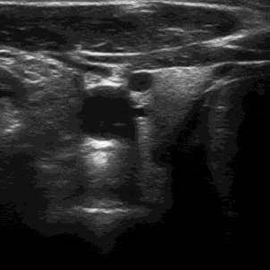 8.3 Srovnání jednotlivých metod na obrázku neck.tif Sejmutý obrázek krku z ultrazvukového přístroje (viz Obr. 44) je silně zašuměný a obsahuje artefakty popsané ve 3. kapitole.