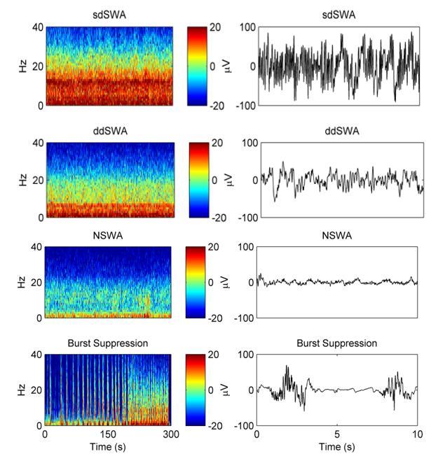 Klasifikace spektrogramů v anestezii sevofluranem spindle-dominant slow wave anest. delta-dominant slow wave anest. non-slow wave a. 95 % 5 % burst suppression a.