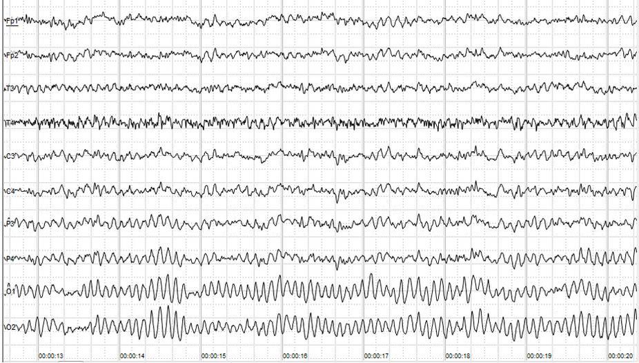 Elektroencefalogram grafoelementy = nejjednodušší složky EEG křivky základní aktivita = sled vln stálé f tranzienty = grafoelementy