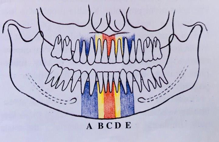 výběžek má nevyhovující sklon pro zavedení implantátů. Z těchto důvodů je větší úspěšnost hybridní náhrady nesené implantáty větší v dolní čelisti. Existuje více protetických schémat.