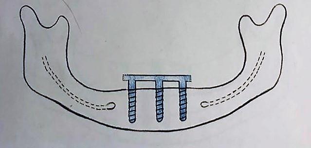 Pro implantaci tedy volíme sektory B a D, kam zavedeme dva implantáty. Tyto implantáty spojíme třmenem. Třmen je možné vestibulárně předsadit před implantáty, ale nesmí mít distálně extendován.