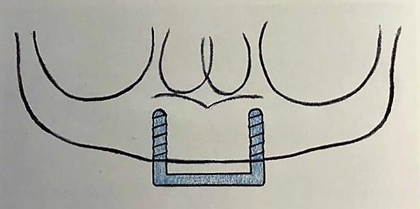 2.10.3 Třída H2 V tomto případě jsou taktéž zaváděny dva implantáty do oblasti špičáků. Implantáty jsou spojeny třmenem.