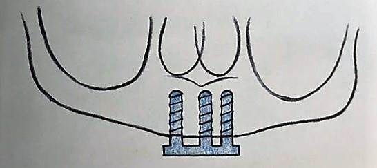 4 Třída H3 V tomto případě se zavádějí tři implantáty do frontálního úseku - do sektorů A, C a D. Implantáty jsou spojeny třmenem.