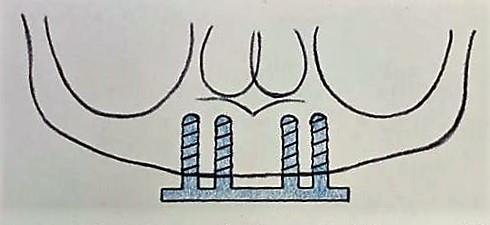 2.10.5 Třída H4 Tato třída obsahuje dvě podtřídy. Podtřída 1 V tomto případě se zavádějí čtyři implantáty do sektorů A, B, D a E. Implantáty jsou spojeny třmenem.
