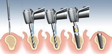 3.2 První chirurgická fáze implantace Válcové implantáty se ve většině případů zavádějí dvoudobě. Dvoudobá implantace představuje dvě chirurgické fáze. V první fázi se zavede do kosti fixtura.