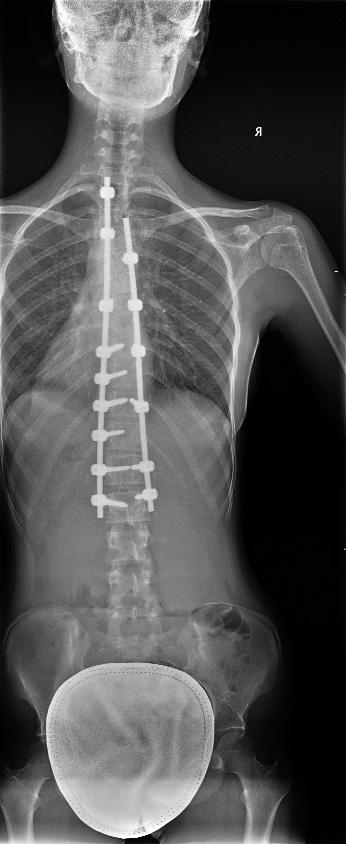 Rozsah finální fúze a instrumentace se řídí celkovou kompenzací páteře a ne vždy musí odpovídat iniciálnímu rozsahu operace při primární implantaci.