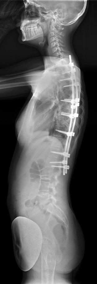 definitivním ošetření 3 roky po primární implantaci (c) a po definitivním ošetření (d).