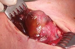 Obr. 1 až 6: Normofunkční cysta příštítného tělíska uloženého intratyreoidálně 45leté nemocné.