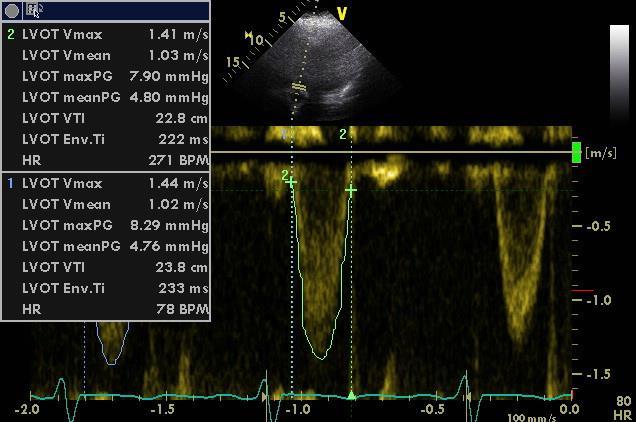 The echocardiography shows: i. Severely dilated left ventricle with restrictive filling pattern ii.