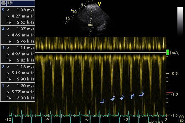 Severely reduced left ventricular contractility with low cardiac output What is the estimated left ventricular end-diastolic pressure? i. 10-15 mmhg ii. 15-20 mmhg iii.