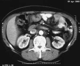 Chemoterapeutick reïim cisplatina/irinotekan byl podáván podle následujícího schématu: cisplatina 80 mg/m 2 den 1. s hydratací a podáním setronû, irinotekan v dávce 200 mg/m 2 den 2.