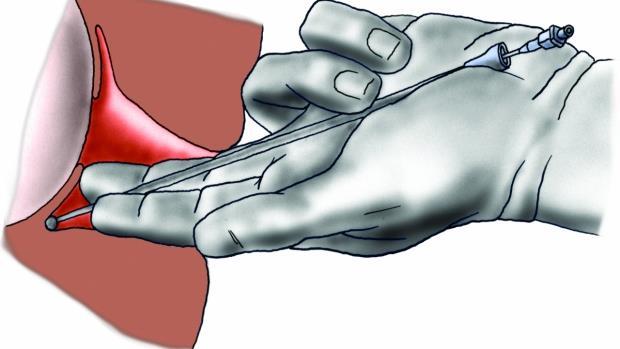 128) Příloha E Paracervikální analgezie