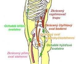 Obr. 4: Svalová dysbalance v rámci dolního zkříženého syndromu (Elektronické výukové materiály, Fakulta sportovních studií MU, 2006). V rámci tohoto syndromu jsou zkráceny flexory kyčelního kloubu (m.